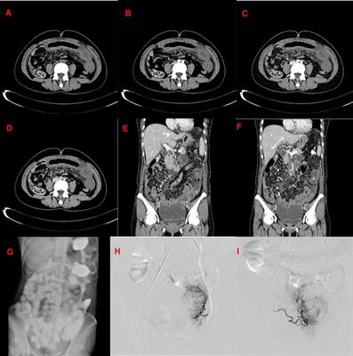 A clinical analysis of intestinal mucosal necrosis and exfoliation induced by superior mesenteric vein thrombosis: A case report